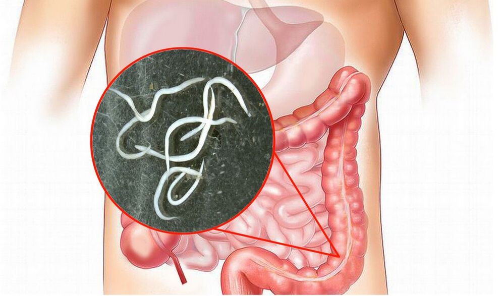 Parásitos en el cuerpo humano sin tratamiento. 