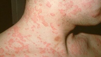 ¿Qué parásitos en el cuerpo pueden causar alergias