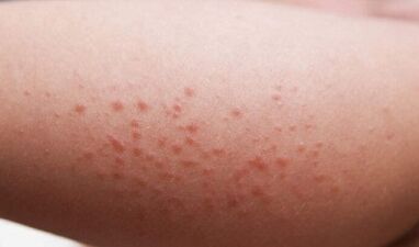 Manifestaciones externas de la presencia de parásitos en el cuerpo.