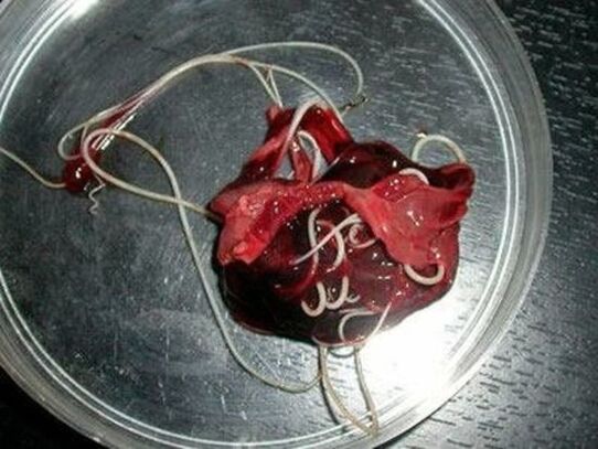 gusanos del cuerpo humano